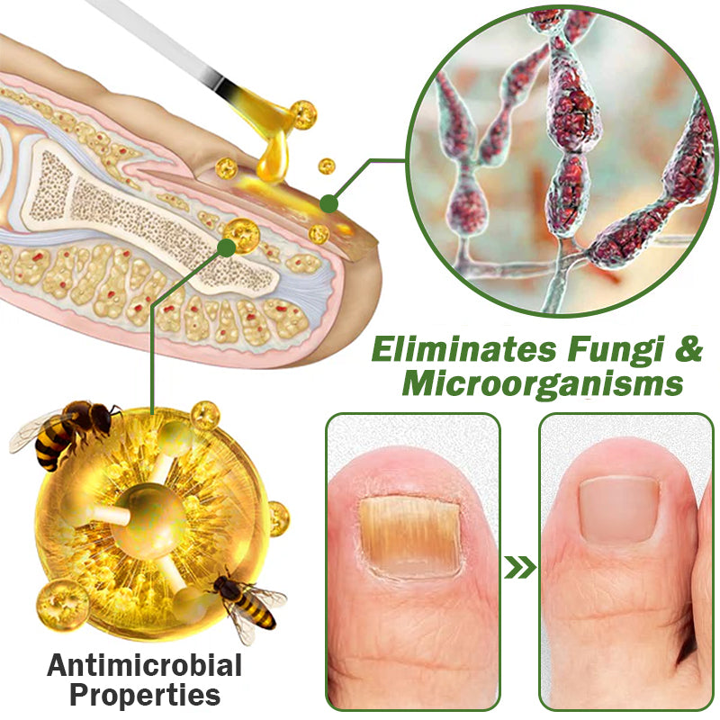 👩⚕️☁️Furzero™ Nail Defense Bee Venom Treatment Serum(For All Kinds Of Nail Diseases✅For Healthier Nail Growth)